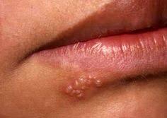 HerpÃ¨s labial