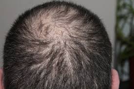 Chute de cheveux
