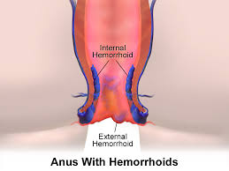 HÃ©morroÃ¯des