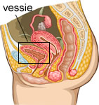 Infection urinaire